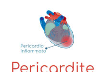 Pericardite che cos’è pericardite